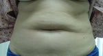 ruth--before lipod.jpg